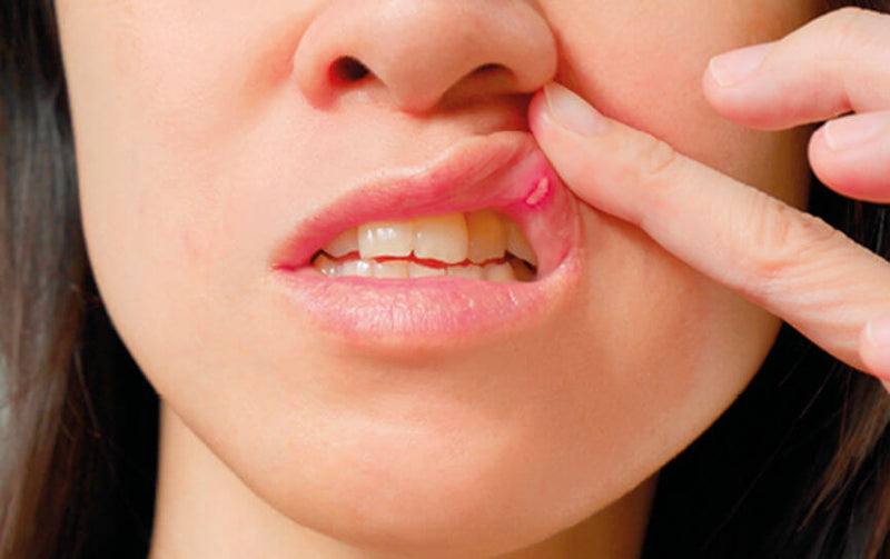 BENU - Zo pak je best een afte aan - Les aphtes : comment s'en débarrasser