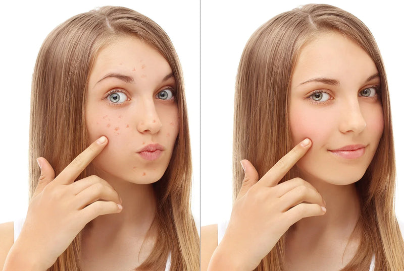 Acne voor en na
