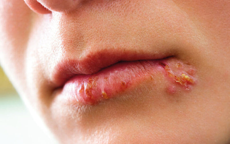 BENU - Lippen om te zoenen - Koortsblaar - Koortsblaren - Bouton de fièvre : Des lèvres à embrasser