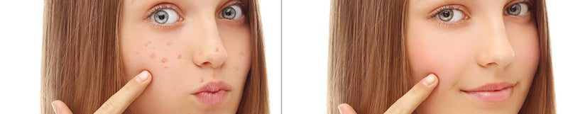 BENU Acné Acne